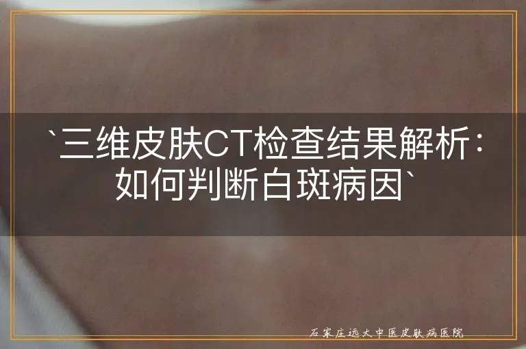 `三维皮肤CT检查结果解析：如何判断白斑病因`