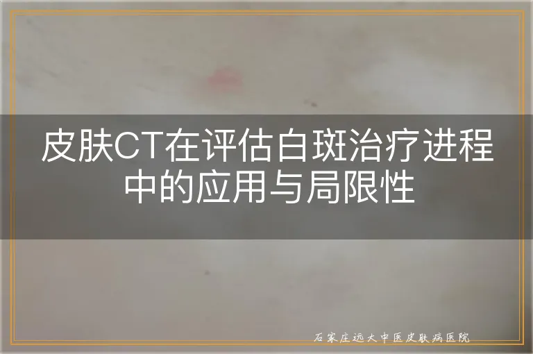 皮肤CT在评估白斑治疗进程中的应用与局限性