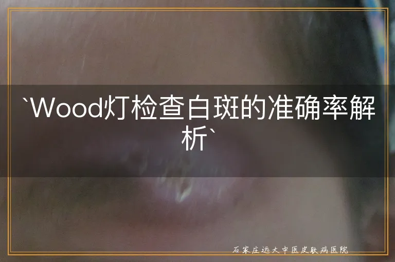 `Wood灯检查白斑的准确率解析`