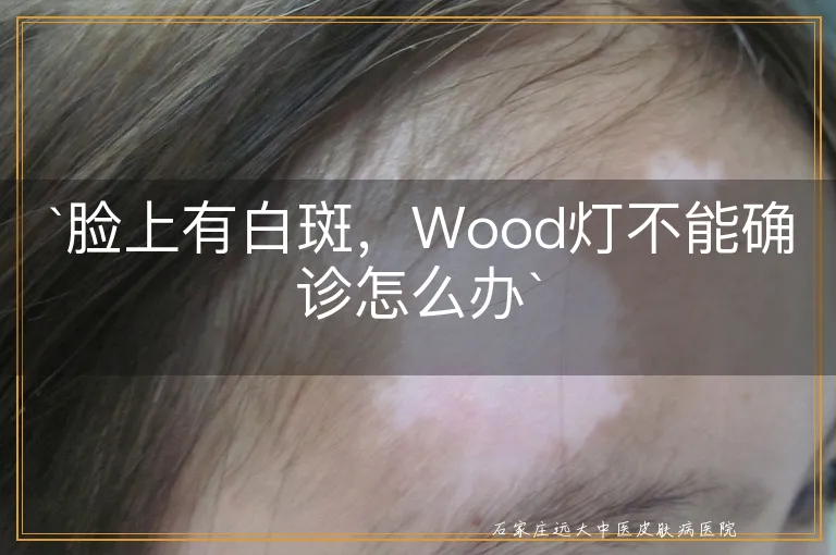 `脸上有白斑，Wood灯不能确诊怎么办`