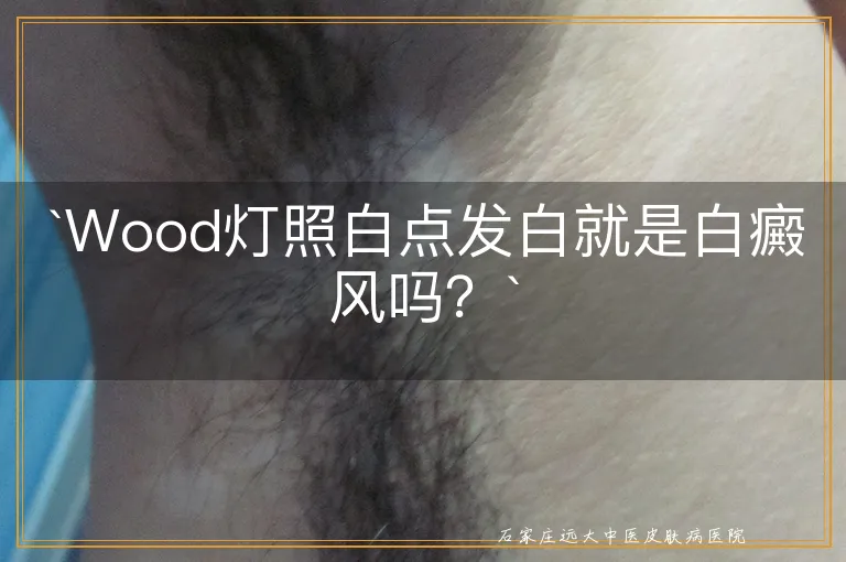 `Wood灯照白点发白就是白癜风吗？`