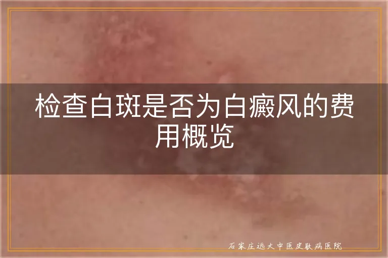 检查白斑是否为白癜风的费用概览