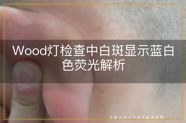 Wood灯检查中白斑显示蓝白色荧光解析