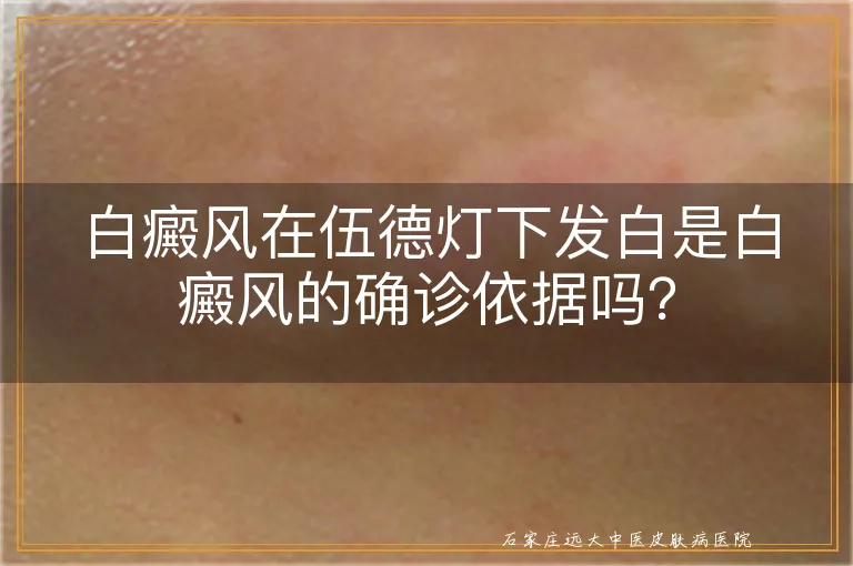 白癜风在伍德灯下发白是白癜风的确诊依据吗？