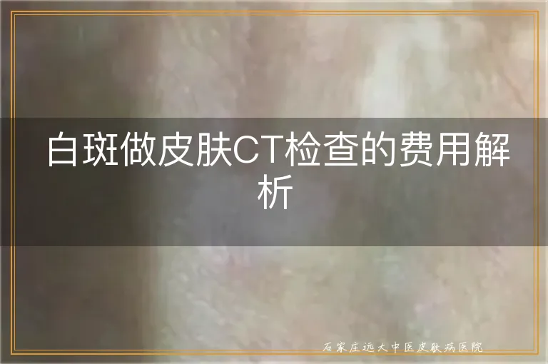 白斑做皮肤CT检查的费用解析