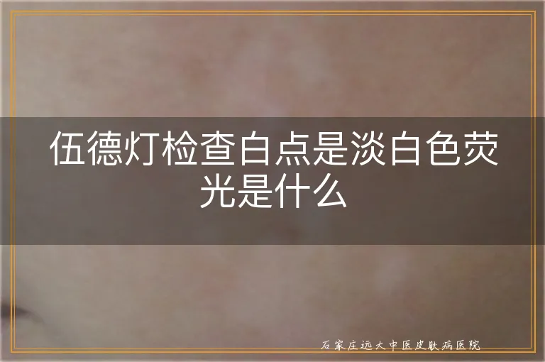 伍德灯检查白点是淡白色荧光是什么