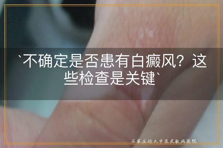 `不确定是否患有白癜风？这些检查是关键`