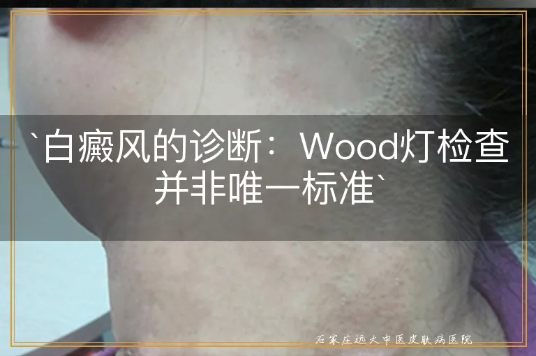 `白癜风的诊断：Wood灯检查并非唯一标准`