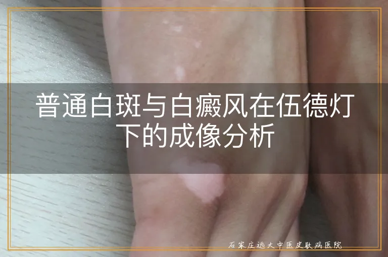 普通白斑与白癜风在伍德灯下的成像分析