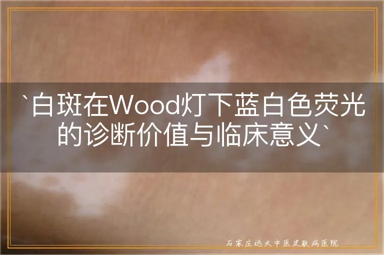 `白斑在Wood灯下蓝白色荧光的诊断价值与临床意义`