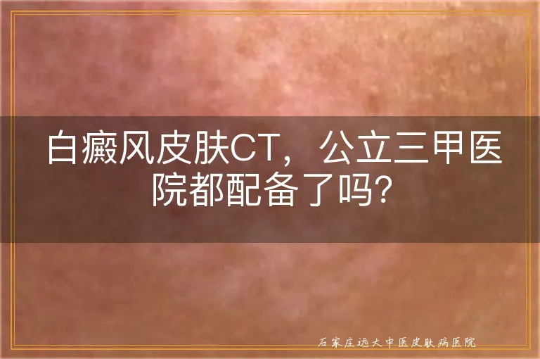 白癜风皮肤CT，公立三甲医院都配备了吗？