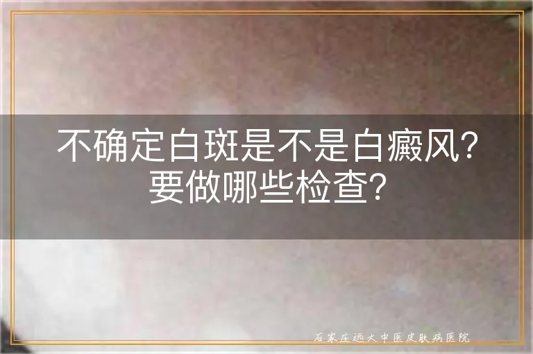 不确定白斑是不是白癜风？要做哪些检查？