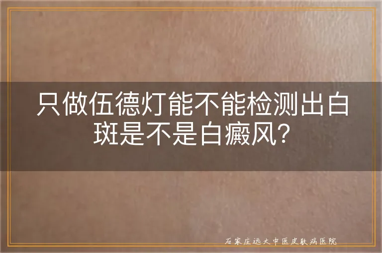 只做伍德灯能不能检测出白斑是不是白癜风？