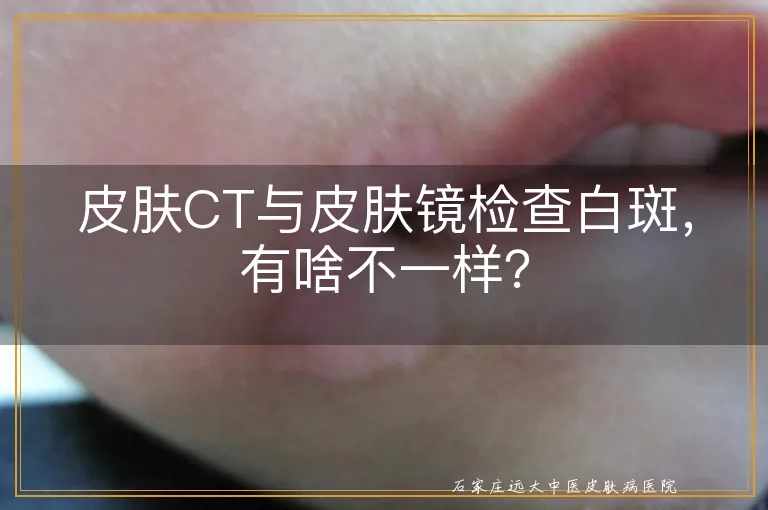 皮肤CT与皮肤镜检查白斑，有啥不一样？