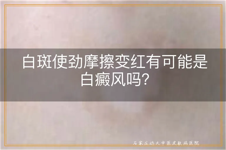 白斑使劲摩擦变红有可能是白癜风吗？