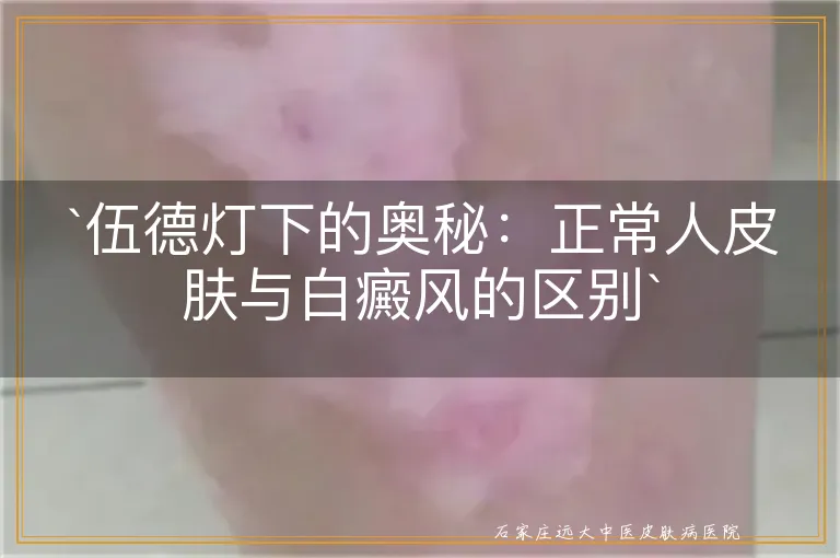 `伍德灯下的奥秘：正常人皮肤与白癜风的区别`