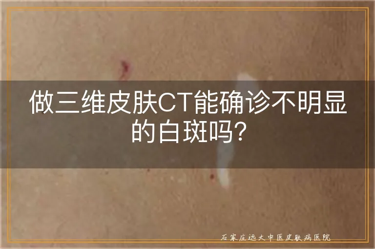 做三维皮肤CT能确诊不明显的白斑吗？