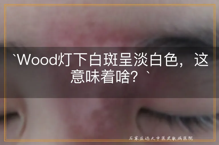 `Wood灯下白斑呈淡白色，这意味着啥？`