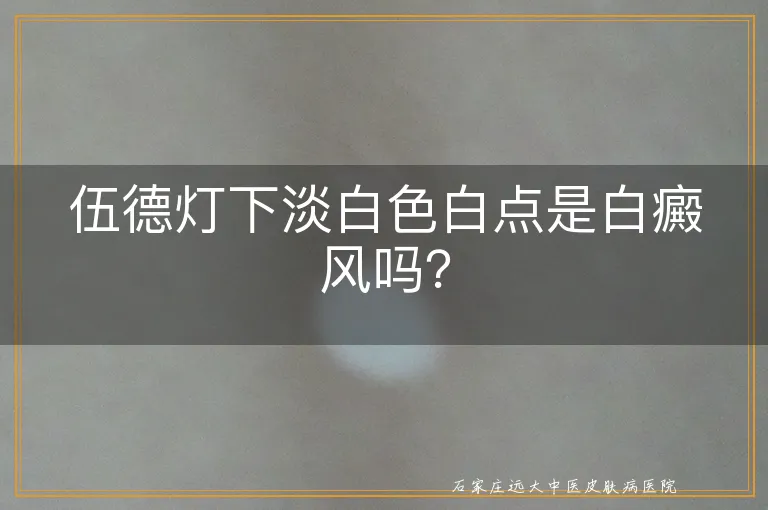 伍德灯下淡白色白点是白癜风吗？