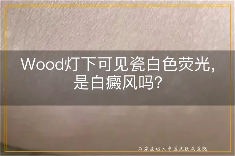 Wood灯下可见瓷白色荧光，是白癜风吗？