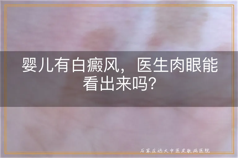 婴儿有白癜风，医生肉眼能看出来吗？