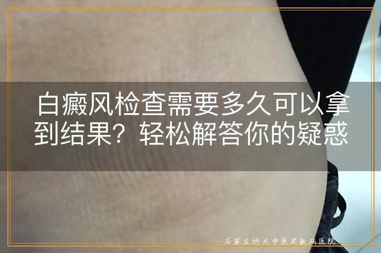 白癜风检查需要多久可以拿到结果？轻松解答你的疑惑