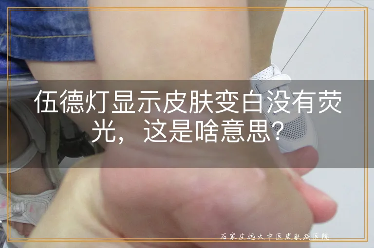 伍德灯显示皮肤变白没有荧光，这是啥意思？