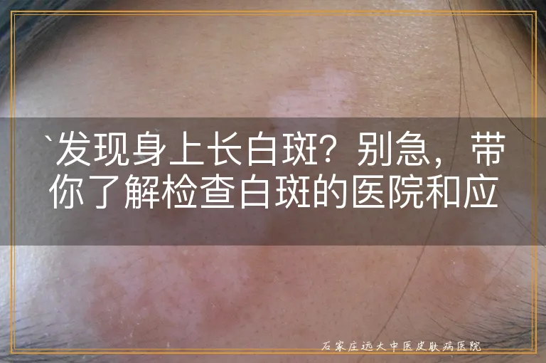 `发现身上长白斑？别急，带你了解检查白斑的医院和应对策略`