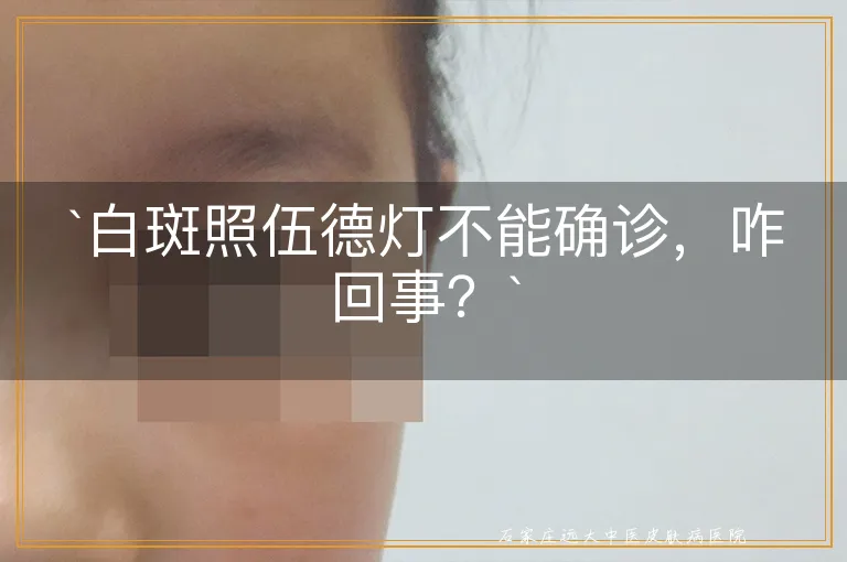 `白斑照伍德灯不能确诊，咋回事？`