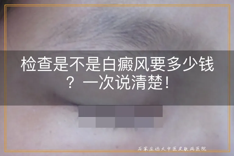 检查是不是白癜风要多少钱？一次说清楚！