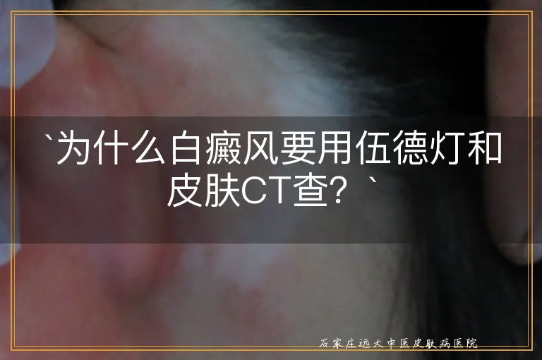 `为什么白癜风要用伍德灯和皮肤CT查？`