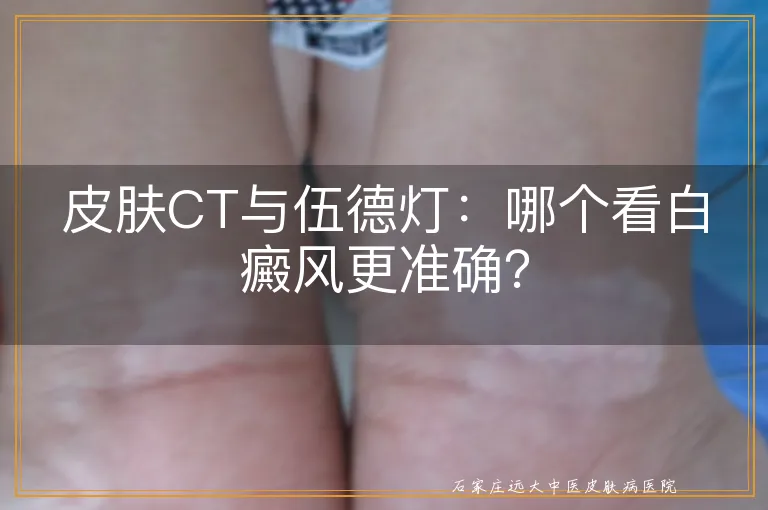 皮肤CT与伍德灯：哪个看白癜风更准确？