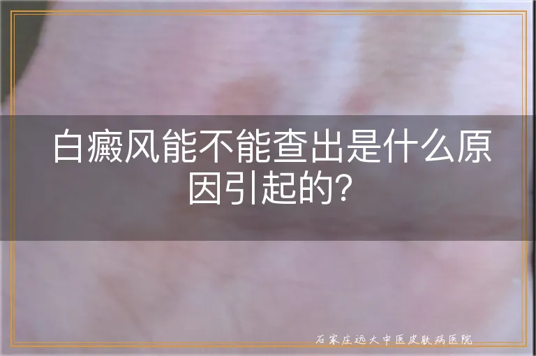 白癜风能不能查出是什么原因引起的？