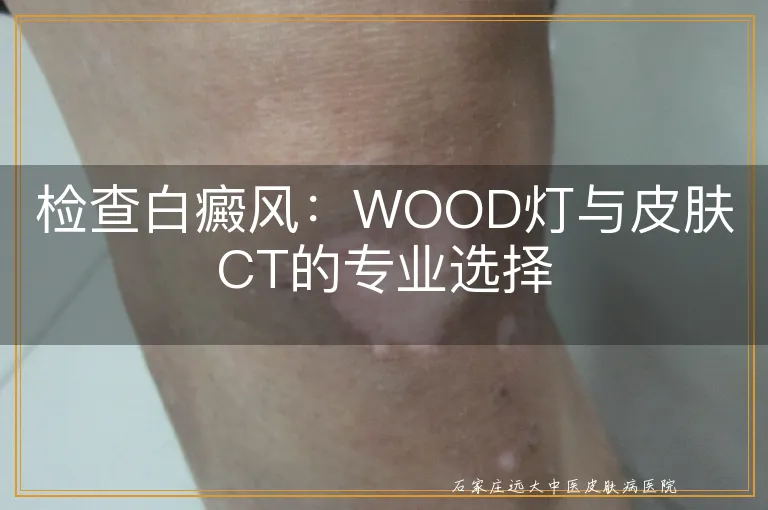 检查白癜风：WOOD灯与皮肤CT的专业选择