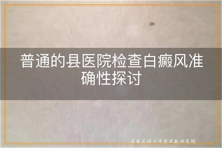 普通的县医院检查白癜风准确性探讨