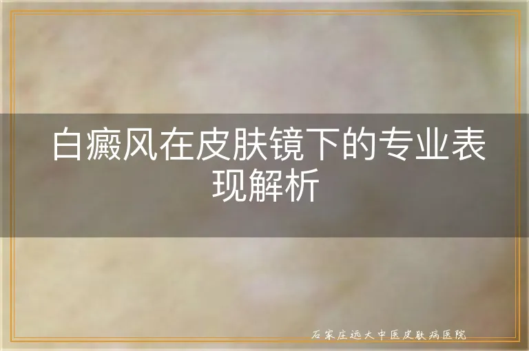 白癜风在皮肤镜下的专业表现解析