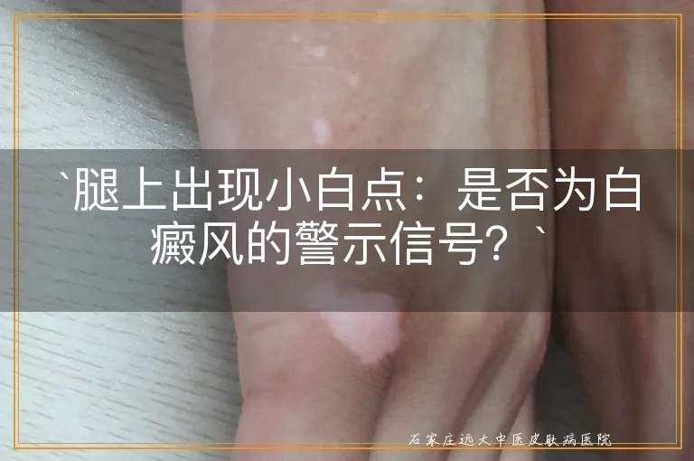 腿上出现小白点：是否为白癜风的警示信号？