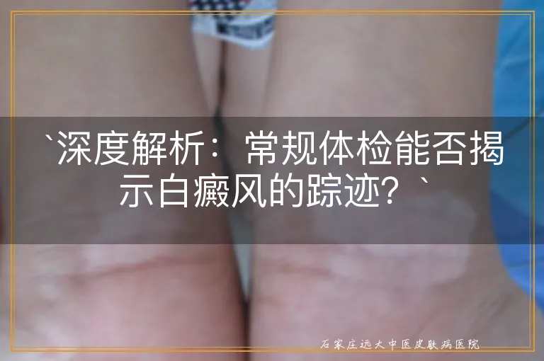 深度解析：常规体检能否揭示白癜风的踪迹？