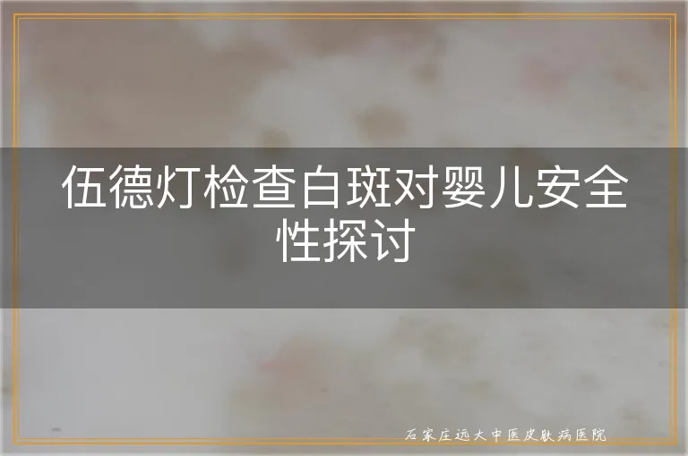 伍德灯检查白斑对婴儿安全性探讨