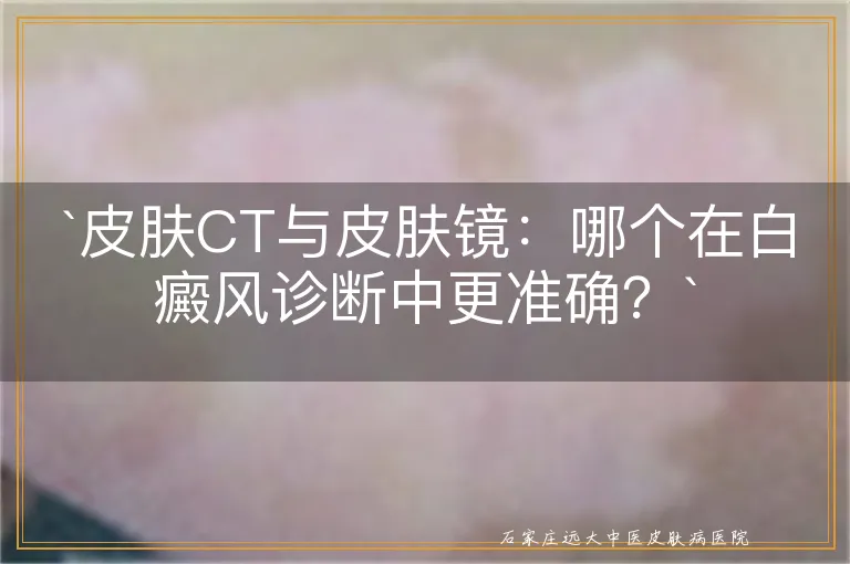 皮肤CT与皮肤镜：哪个在白癜风诊断中更准确？