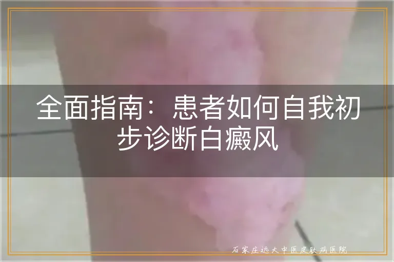 全面指南：患者如何自我初步诊断白癜风