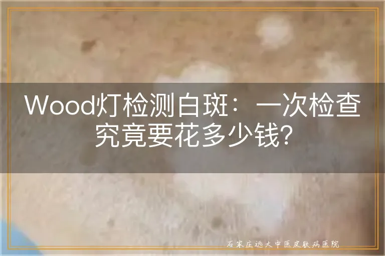 Wood灯检测白斑：一次检查究竟要花多少钱？