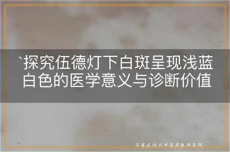 探究伍德灯下白斑呈现浅蓝白色的医学意义与诊断价值