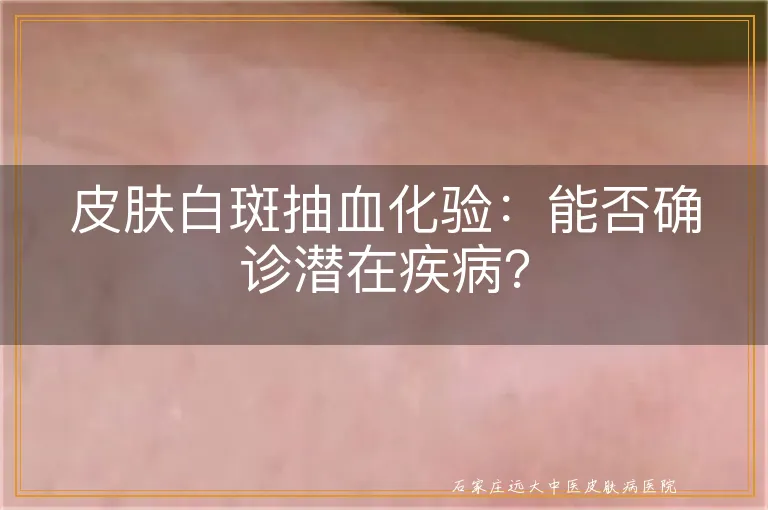 皮肤白斑抽血化验：能否确诊潜在疾病？