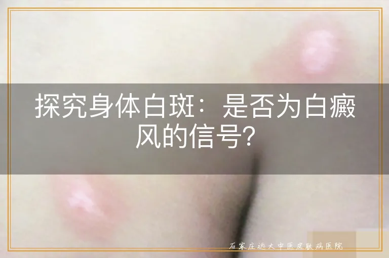 探究身体白斑：是否为白癜风的信号？