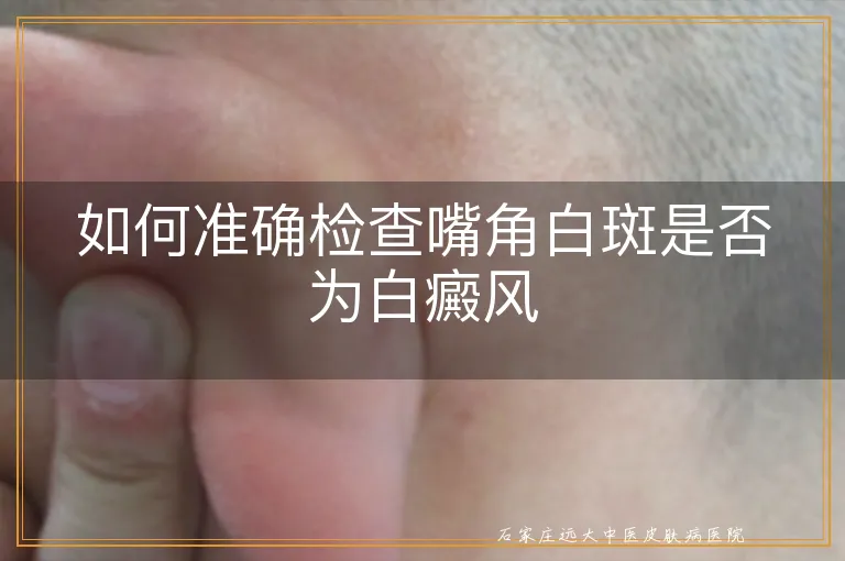 如何准确检查嘴角白斑是否为白癜风