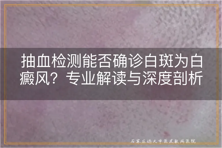 抽血检测能否确诊白斑为白癜风？专业解读与深度剖析