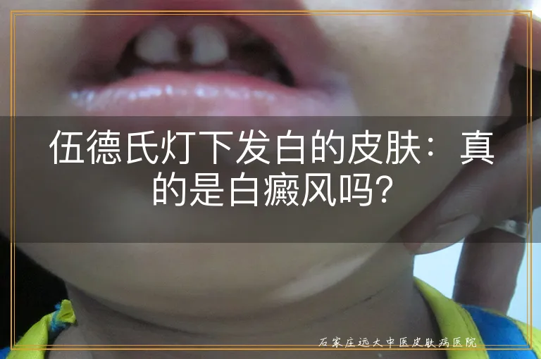 伍德氏灯下发白的皮肤：真的是白癜风吗？