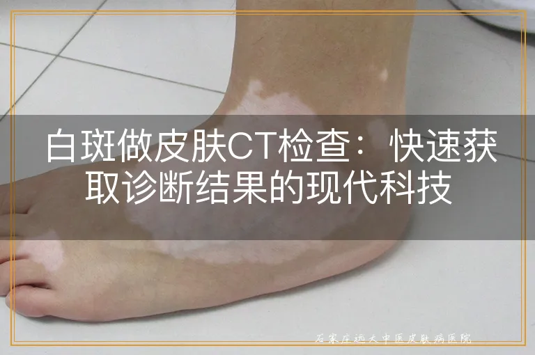 白斑做皮肤CT检查：快速获取诊断结果的现代科技