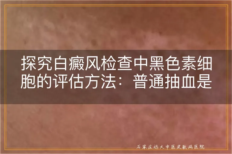 探究白癜风检查中黑色素细胞的评估方法：普通抽血是否可行？